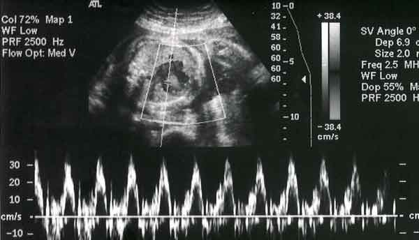 У одной из восьми рожениц Бельгии выявляют гестационный диабет