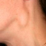 Десятки сообщений в день о воспаленных лимфоузлах после бустерной вакцины