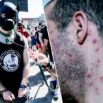 Первые случаи заражения обезьяньей оспой в Бельгии были выявлены у участников так называемого «фетиш-фестиваля»