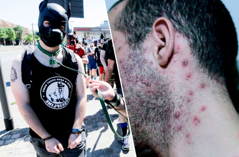 Первые случаи заражения обезьяньей оспой в Бельгии были выявлены у участников так называемого «фетиш-фестиваля»