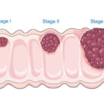Тревожная статистика: 85% брюссельцев игнорируют тест на рак кишечника