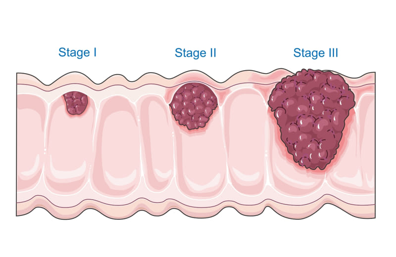 Тревожная статистика: 85% брюссельцев игнорируют тест на рак кишечника