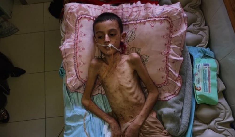 Паралич и смерть среди детей в Газе: врач из Нидерландов бьёт тревогу